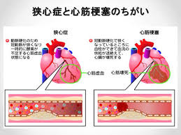 東京で狭心症でお困りの方は 飯田橋ota整体院まで